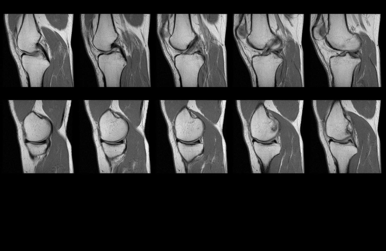 ACL tear vs meniscus tear difference in Bangalore